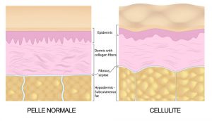 cellulite esterno coscia